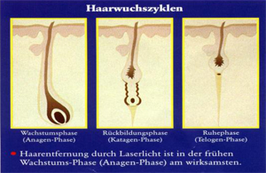 Laser Epilation Haarentfernung Privatklinik Hagenmuhle
